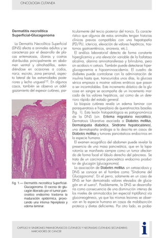 Dermatitis necrolítica
Superficial-Glucagonoma
La Dermatitis Necrolítica Superficial
(DNS) afecta a animales adultos y se
caracteriza por el desarrollo de pla-
cas eritematosas, úlceras y costras
distribuidas principalmente en abdo-
men ventral y almohadillas, exten-
diéndose en ocasiones a codos,
nariz, escroto, zona perianal, aspec-
to lateral de las extremidades poste-
riores y lecho ungueal10. En algunos
casos, también se observa un adel-
gazamiento del espesor cutáneo, par-
ticularmente del tercio posterior del tronco. Es caracte-
rístico que algunos de estos animales tengan historias
clínicas previas compatibles con una hepatopatía
(PD/PU, ictericia, elevación de valores hepáticos, tras-
tornos gastroentéricos, anorexia, etc.).
El análisis laboratorial detecta de forma constante
hiperglicemia y una elevación variable de la fosfatasa
alcalina, alanina aminotransferasa y bilirrubina, pero
sin acidosis ni cetosis. También puede detectarse hiper-
glucagonemia e hipoaminoacidemia. El cuadro de
diabetes puede controlarse con la administración de
insulina hasta que, transcurridos unos días, la glucosa
sérica empieza a mostrar valores erráticos que pasan
a ser incontrolables. Este incremento drástico de la glu-
cosa en sangre se acompaña de un incremento mar-
cado de los valores hepáticos, así como de un dete-
rioro rápido del estado general.
La biopsia cutánea revela un edema laminar con
paraqueratosis e hiperplasia de queratinocitos basales
(fig. 1). Esta lesión histopatológica es patognomónica
de la DNS (sin. Eritema migratorio necrolítico,
Dermatosis Ulcerativa asociada a Diabetes mellitus,
Dermatopatía diabética, Síndrome hepatocutáneo),
una dermatopatía análoga a la descrita en casos de
Diabetes mellitus y tumores pancréaticos endocrinos en
la especie humana.
El examen ecográfico del abdomen puede revelar la
presencia de una masa pancreática, que en la lapa-
rotomía se manifiesta siempre como un tumor afectan-
do de forma focal el lóbulo derecho del páncreas. Se
trata de un carcinoma pancreático endocrino produc-
tor de glucagón (glucagonoma).
La asociación de Diabetes mellitus sin cetoacidosis y
DNS se conoce en el hombre como "Síndrome del
Glucagonoma". En el perro, solamente en un caso de
DNS se han demostrado valores elevados de gluca-
gón en el suero2. Posiblemente, la DNS se desarrolla-
ría como consecuencia de una disminución intensa de
los niveles de aminoácidos (en especial triptófano) vía
gluconeogénesis, ya que las mismas lesiones se obser-
van en la especie humana en casos de malabsorción
proteica y dietas deficientes. Por otro lado, es proba-
CAPITULO IV SINDROMES PARANEOPLASICOS CUTANEOS Y NEOPLASIAS CUTANEAS SECUNDARIAS:
MARCADORES DE CANCER
ONCOLOGIA CUTANEA
i
Fig. 1.— Dermatitis necrolítica Superficial-
Glucagonoma. El exceso de glu-
cagón liberado por el tumor pan-
creático endocrino trastorna la
maduración epidérmica, provo-
cando una intensa hiperplasia y
edema laminar.
 