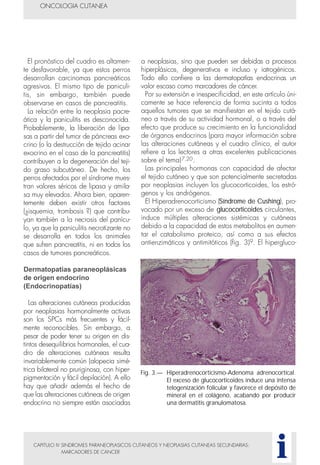 a neoplasias, sino que pueden ser debidas a procesos
hiperplásicos, degenerativos e incluso y iatrogénicos.
Todo ello confiere a las dermatopatías endocrinas un
valor escaso como marcadores de cáncer.
Por su extensión e inespecificidad, en este artículo úni-
camente se hace referencia de forma sucinta a todos
aquellos tumores que se manifiestan en el tejido cutá-
neo a través de su actividad hormonal, o a través del
efecto que produce su crecimiento en la funcionalidad
de órganos endocrinos (para mayor información sobre
las alteraciones cutáneas y el cuadro clínico, el autor
refiere a los lectores a otras excelentes publicaciones
sobre el tema)7,20.
Las principales hormonas con capacidad de afectar
el tejido cutáneo y que son potencialmente secretadas
por neoplasias incluyen los glucocorticoides, los estró-
genos y los andrógenos.
El Hiperadrenocorticismo (Síndrome de Cushing), pro-
vocado por un exceso de glucocorticoides circulantes,
induce múltiples alteraciones sistémicas y cutáneas
debido a la capacidad de estos metabolitos en aumen-
tar el catabolismo proteico, así como a sus efectos
antienzimáticos y antimitóticos (fig. 3)9. El hipergluco-
CAPITULO IV SINDROMES PARANEOPLASICOS CUTANEOS Y NEOPLASIAS CUTANEAS SECUNDARIAS:
MARCADORES DE CANCER
El pronóstico del cuadro es altamen-
te desfavorable, ya que estos perros
desarrollan carcinomas pancreáticos
agresivos. El mismo tipo de paniculi-
tis, sin embargo, también puede
observarse en casos de pancreatitis.
La relación entre la neoplasia pacre-
ática y la paniculitis es desconocida.
Probablemente, la liberación de lipa-
sas a partir del tumor de páncreas exo-
crino (o la destrucción de tejido acinar
exocrino en el caso de la pancreatitis)
contribuyen a la degeneración del teji-
do graso subcutáneo. De hecho, los
perros afectados por el síndrome mues-
tran valores séricos de lipasa y amila-
sa muy elevados. Ahora bien, aparen-
temente deben existir otros factores
(¿isquemia, trombosis ?) que contribu-
yan también a la necrosis del panícu-
lo, ya que la paniculitis necrotizante no
se desarrolla en todos los animales
que sufren pancreatitis, ni en todos los
casos de tumores pancreáticos.
Dermatopatías paraneoplásicas
de origen endocrino
(Endocrinopatías)
Las alteraciones cutáneas producidas
por neoplasias hormonalmente activas
son los SPCs más frecuentes y fácil-
mente reconocibles. Sin embargo, a
pesar de poder tener su origen en dis-
tintos desequilibrios hormonales, el cua-
dro de alteraciones cutáneas resulta
invariablemente común (alopecia simé-
trica bilateral no pruriginosa, con hiper-
pigmentación y fácil depilación). A ello
hay que añadir además el hecho de
que las alteraciones cutáneas de origen
endocrino no siempre están asociadas
ONCOLOGIA CUTANEA
i
Fig. 3.— Hiperadrenocorticismo-Adenoma adrenocortical.
El exceso de glucocorticoides induce una intensa
telogenización folicular y favorece el depósito de
mineral en el colágeno, acabando por producir
una dermatitis granulomatosa.
 