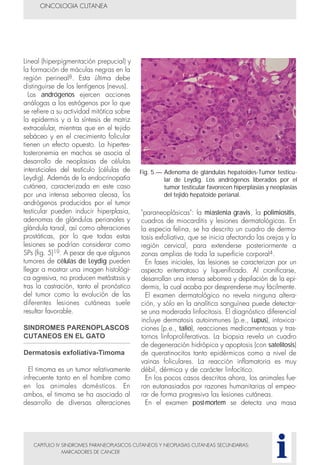 "paraneoplásicas": la miastenia gravis, la polimiositis,
cuadros de miocarditis y lesiones dermatológicas. En
la especia felina, se ha descrito un cuadro de derma-
tosis exfoliativa, que se inicia afectando las orejas y la
región cervical, para extenderse posteriormente a
zonas amplias de toda la superficie corporal4.
En fases iniciales, las lesiones se caracterizan por un
aspecto eritematoso y liquenificado. Al cronificarse,
desarrollan una intensa seborrea y depilación de la epi-
dermis, la cual acaba por desprenderse muy fácilmente.
El examen dermatológico no revela ninguna altera-
ción, y sólo en la analítica sanguínea puede detectar-
se una moderada linfocitosis. El diagnóstico diferencial
incluye dermatosis autoinmunes (p.e., Lupus), intoxica-
ciones (p.e., talio), reacciones medicamentosas y tras-
tornos linfoproliferativos. La biopsia revela un cuadro
de degeneración hidrópica y apoptosis (con satelitosis)
de queratinocitos tanto epidérmicos como a nivel de
vainas foliculares. La reacción inflamatoria es muy
débil, dérmica y de carácter linfocítico.
En los pocos casos descritos ahora, los animales fue-
ron eutanasiados por razones humanitarias al empeo-
rar de forma progresiva las lesiones cutáneas.
En el examen post-mortem se detecta una masa
CAPITULO IV SINDROMES PARANEOPLASICOS CUTANEOS Y NEOPLASIAS CUTANEAS SECUNDARIAS:
MARCADORES DE CANCER
Lineal (hiperpigmentación prepucial) y
la formación de máculas negras en la
región perineal8. Esta última debe
distinguirse de los lentígenos (nevus).
Los andrógenos ejercen acciones
análogas a los estrógenos por lo que
se refiere a su actividad mitótica sobre
la epidermis y a la síntesis de matriz
extracelular, mientras que en el tejido
sebáceo y en el crecimiento folicular
tienen un efecto opuesto. La hipertes-
tosteronemia en machos se asocia al
desarrollo de neoplasias de células
intersticiales del testículo (células de
Leydig). Además de la endocrinopatía
cutánea, caracterizada en este caso
por una intensa seborrea oleosa, los
andrógenos producidos por el tumor
testicular pueden inducir hiperplasia,
adenomas de glándulas perianales y
glándula tarsal, así como alteraciones
prostáticas, por lo que todas estas
lesiones se podrían considerar como
SPs (fig. 5)19. A pesar de que algunos
tumores de células de Leydig pueden
llegar a mostrar una imagen histológi-
ca agresiva, no producen metástasis y
tras la castración, tanto el pronóstico
del tumor como la evolución de las
diferentes lesiones cutáneas suele
resultar favorable.
SINDROMES PARENOPLASCOS
CUTANEOS EN EL GATO
Dermatosis exfoliativa-Timoma
El timoma es un tumor relativamente
infrecuente tanto en el hombre como
en los animales domésticos. En
ambos, el timoma se ha asociado al
desarrollo de diversas alteraciones
ONCOLOGIA CUTANEA
i
Fig. 5.— Adenoma de glándulas hepatoides-Tumor testicu-
lar de Leydig. Los andrógenos liberados por el
tumor testicular favorecen hiperplasias y neoplasias
del tejido hepatoide perianal.
 