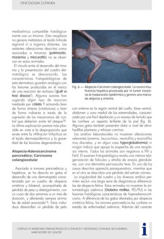 con eritema en la región ventral del cuello, tórax ventral,
abdomen y cara medial de las extremidades, caracteri-
zada por una fácil depilación y un exceso de lamido que
les confiere un aspecto brillante de la piel (fig. 6).
Algunos gatos también presentan dolor a nivel de almo-
hadillas plantares y rehúsan caminar.
Los análisis laboratoriales no muestran alteraciones
relevantes (anemia, leucocitosis, neutrofilia y eosinofilia
muy discretas, y en algun caso hyperglobulinemia) ni
ningún indicio que apoye la sospecha de una neopla-
sia interna. Todos los animales son negativos a FIV y
FeLV. El examen histopatológico revela una intensa telo-
genización de folículos y atrofia de anejos glandula-
res, con una dermatitis perivascular leve. En uno de los
casos descritos aparecía paraqueratosis, mientras que
en el otro se describía una pérdida del estrato córneo.
La singularidad del cuadro y los diversos análisis per-
miten excluir una larga serie de diagnósticos diferencia-
les de alopecia felina. Estos animales no muestran la sin-
tomatología sistémica (Diabetes mellitus, PD/PU) ni las
lesiones histológicas características de hiperadrenocorti-
cismo. A diferencia de los gatos afectados por alopecia
simétrica felina, los tumores pancreáticos les confiere un
estado de enfermedad sistémica. Además del carácter
CAPITULO IV SINDROMES PARANEOPLASICOS CUTANEOS Y NEOPLASIAS CUTANEAS SECUNDARIAS:
MARCADORES DE CANCER
mediastínica compatible histológica-
mente con un timoma. Esta neoplasia
no genera metástasis al tejido linfoide
regional ni a órganos distantes. Las
restantes alteraciones descritas como
asociadas a timomas (polimiositis,
miastenia y miocarditis) no se obser-
van en estos animales.
El vínculo entre el desarrollo del timo-
ma y la presentación del cuadro der-
matológico es desconocido. Las
características histopatológicas de
esta dermatosis guardan analogía con
las lesiones producidas en el marco
de una reacción de rechazo ("graft vs
host disease"). Algunos autores han
sugerido algún tipo de reaccion
mediada por células T actuando bien
de forma directa (citotóxicas) o bien
de forma indirecta a través de la
supresión de los mecanismos de con-
trol que deberían evitar tal ataque28.
La última explicación parece más plau-
sible en vista a la desproporción que
existe entre la infiltración linfocítica en
el tejido dermoepidérmico y la grave-
dad de las lesiones degenerativas.
Alopecia-Adenocarcinoma
pancreático; Carcinoma
colangiocelular
Asociada a tumores pancreáticos y
hepáticos, se ha descrito en gatos el
desarrollo de una dermatopatía carac-
terizada por un cuadro de alopecia
simétrica y bilateral, acompañada de
pérdida de peso y aletargamiento, con
un curso de dos semanas a un mes de
duración, y afectando siempre anima-
les de edad avanzada16. Estos indivi-
duos desarrollan un pérdida de pelo
ONCOLOGIA CUTANEA
i
Fig. 6.— Alopecia-Carcinom colangiocelular. La severa insu-
ficiencia hepática provocada por el tumor trastor-
na la maduración epidérmica y genera una marca-
da alopecia y eritema.
 
