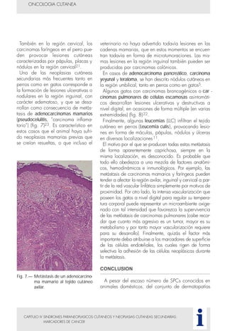 También en la región cervical, los
carcinomas faríngeos en el perro pue-
den provocar lesiones cutáneas
caracterizadas por pápulas, placas y
nódulos en la región cervical21.
Una de las neoplasias cutáneas
secundarias más frecuentes tanto en
perros como en gatos corresponde a
la formación de lesiones ulcerativas o
nodulares en la región inguinal, con
carácter edematoso, y que se desa-
rrollan como consecuencia de metás-
tasis de adenocarcinomas mamarios
(pseudocelulitis, “carcinoma inflama-
torio”) (fig. 7)23. Es característico en
estos casos que el animal haya sufri-
do neoplasias mamarias previas que
se creían resueltas, o que incluso el
CAPITULO IV SINDROMES PARANEOPLASICOS CUTANEOS Y NEOPLASIAS CUTANEAS SECUNDARIAS:
MARCADORES DE CANCER
veterinario no haya advertido todavía lesiones en las
cadenas mamarias, que en estos momentos se encuen-
tran todavía en forma de microtumoraciones. Las mis-
mas lesiones en la región inguinal también pueden ser
producidas por carcinomas colónicos.
En casos de adenocarcinoma pancreático, carcinoma
yeyunal y teratoma, se han descrito nódulos cutáneos en
la región umbilical, tanto en perros como en gatos5.
Algunos gatos con carcinomas broncogénicos o car -
cinomas pulmonares de células escamosas asintomáti-
cos desarrollan lesiones ulcerativas y destructivas a
nivel digital, en ocasiones de forma múltiple (en varias
extremidades) (fig. 8)22.
Finalmente, algunas leucemias (LLC) infiltran el tejido
cutáneo en perros (Leucemia cutis), provocando lesio-
nes en forma de máculas, pápulas, nódulos y úlceras
en diversas localizaciones11.
El motivo por el que se producen todas estas metástasis
de forma aparentemente caprichosa, siempre en la
misma localización, es desconocido. Es probable que
todo ello obedezca a una mezcla de factores anatómi-
cos, hemodinámicos e inmunológicos. Por ejemplo, las
metástasis de carcinomas mamarios y faríngeos pueden
tender a afectar la región axilar, inguinal y cervical a par-
tir de la red vascular linfática simplemente por motivos de
proximidad. Por otro lado, la intensa vascularización que
poseen los gatos a nivel digital para regular su tempera-
tura corporal puede representar un microambiente oxige-
nado con tal intensidad que favorezca la supervivencia
de las metástasis de carcinomas pulmonares (cabe recor-
dar que cuanto más agresivo es un tumor, mayor es su
metabolismo y por tanto mayor vascularización requiere
para su desarrollo). Finalmente, quizás el factor más
importante deba atribuirse a los marcadores de superficie
de las células endoteliales, los cuales rigen de forma
selectiva la adhesión de las células neoplásicas durante
la metástasis.
CONCLUSION
A pesar del escaso número de SPCs conocidos en
animales domésticos, del conjunto de dermatopatías
ONCOLOGIA CUTANEA
i
Fig. 7.— Metástasis de un adenocarcino-
ma mamario al tejido cutáneo
axilar.
 