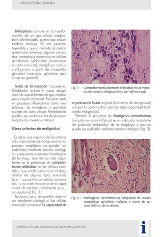 organización tisular original (indicativo de benignidad)
o si por lo contrario han perdido esta capacidad (indi-
cando malignidad).
También la presencia de linfangiosis carcinomatosa
(invasión de vasos linfáticos) es un indicador importante
del potencial metastático de la neoplasia y que no
puede ser evaluado mediante estudio citológico (fig. 2).
Metaplasia consiste en la transfor-
mación de un tipo celular maduro,
bien diferenciado, a otro tipo celular
también maduro. Es una situación
reversible y que a menudo se asocia
a estímulos externos, algunos conoci-
dos: metaplasia escamosa en células
glandulares (glándulas ceruminosas
en otitis crónicas), metaplasia ósea o
cartilaginosa a partir de mioepitelio
glandular (mamario, glándulas apo-
crinas en general).
Tejido de Granulación: Consiste en
fibroblastos activos y vasos sanguí-
neos de nueva formación que constitu-
yen el tejido cicatricial, frecuente tanto
en procesos inflamatorios como neo-
plásicos. La inmadurez y actividad
nuclear de estas células fibroblásticas
pueden ser similares a las de procesos
neoplásicos mesenquimatosos.
Otros criterios de malignidad
Es obvio que algunos de los criterios
más importantes de malignidad en un
proceso neoplásico no pueden ser
evaluados mediante estudio citológi-
co y requieren un examen histológico
de la masa. Uno de los más impor-
tantes es la presencia de comporta -
miento infiltrativo de las células tumo-
rales, que resulta esencial en el diag-
nóstico de algunos tipos tumorales
(p.ej., carcinoma de células escamo-
sas) y va a ser indicativo de la capa-
cidad de recidivar localmente (p.ej.,
mastocitoma) (fig. 1).
Tampoco va a ser posible determi-
nar mediante citología si las células
tumorales conservan la capacidad de
CAPITULO I ESTUDIO CITOLOGICO DE NEOPLASIAS CUTANEAS
ONCOLOGIA CUTANEA
i
Fig. 1.— Comportamiento altamente infiltrativo en un masto-
citoma canino citológicamente bien diferenciado.
Fig. 2.— Linfangiosis carcinomatosa. Migración de células
neoplásicas epiteliales malignas a través de un
vaso linfático de la dermis.
 