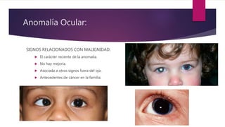 Anomalía Ocular:
SIGNOS RELACIONADOS CON MALIGNIDAD:
 El carácter reciente de la anomalía.
 No hay mejoría.
 Asociada a otros signos fuera del ojo.
 Antecedentes de cáncer en la familia.
 