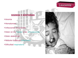 Leucemia
SIGNOS Y SÍNTOMAS
Anemia
Hematomas
Infecciones recurrentes
Dolor en los huesos y las articulaciones
Dolor abdominal
Nódulos linfáticos inflamados
Dificultad respiratoria

 