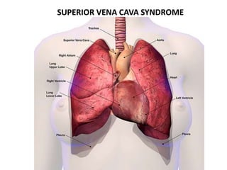 SUPERIOR VENA CAVA SYNDROME
 