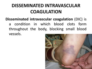 DISSEMINATED INTRAVASCULAR
COAGULATION
Disseminated intravascular coagulation (DIC) is
a condition in which blood clots form
throughout the body, blocking small blood
vessels.
 