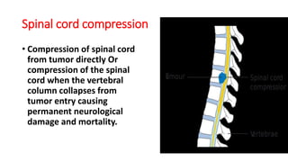 Spinal cord compression
• Compression of spinal cord
from tumor directly Or
compression of the spinal
cord when the vertebral
column collapses from
tumor entry causing
permanent neurological
damage and mortality.
 