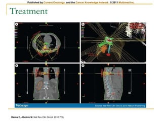 Treatment Rades D, Abrahm M.  Nat Rev Clin Oncol. 2010;7(9). 