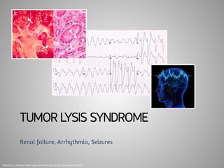 TUMOR LYSIS SYNDROME 
Renal failure, Arrhythmia, Seizures 
http://circ.ahajournals.org/content/116/1/e2/F3.expansion.html 
 