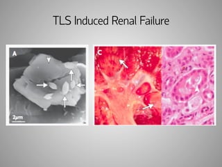 TLS Induced Renal Failure 
 