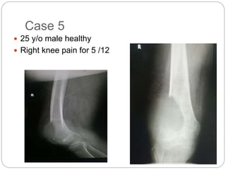 Case 5
 25 y/o male healthy
 Right knee pain for 5 /12
 