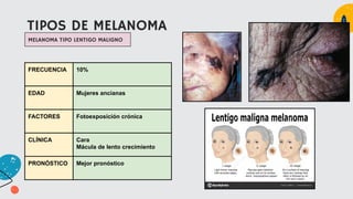 TIPOS DE MELANOMA
MELANOMA TIPO LENTIGO MALIGNO
FRECUENCIA 10%
EDAD Mujeres ancianas
FACTORES Fotoexposición crónica
CLÍNICA Cara
Mácula de lento crecimiento
PRONÓSTICO Mejor pronóstico
 