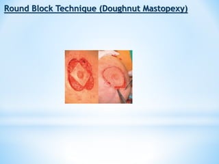 Oncoplastic final | PPT