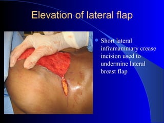 Undermining Incision Breast Preservation Foundation: Oncoplastic Talk, Dallas, 12/5/09 | PPT
