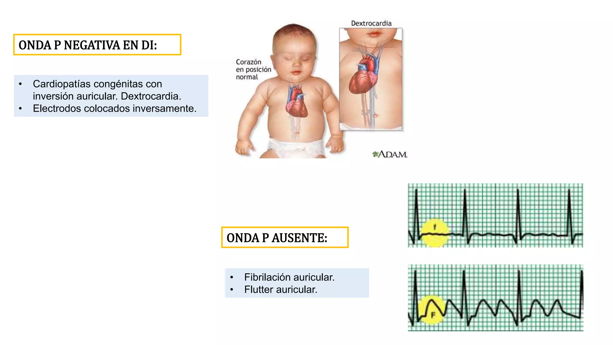Onda P e intervalo PR.pptx
