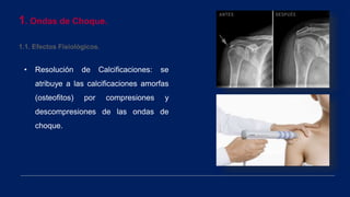 1. Ondas de Choque.
1.1. Efectos Fisiológicos.
• Resolución de Calcificaciones: se
atribuye a las calcificaciones amorfas
(osteofitos) por compresiones y
descompresiones de las ondas de
choque.
 