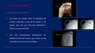 1. Ondas de Choque.
1.1. Mecanismo de Acción.
• Las ondas de choque tiene la capacidad de
producir destrozos a nivel de las células y los
tejidos, que, tras una respuesta inflamatoria,
llevan a su reconstrucción.
• Con ello, normalmente desaparecen los
problemas del dolor crónico que suelen ser los
motivadores de este tipo de terapias.
 