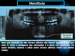 “Remendo”
de titânio

 