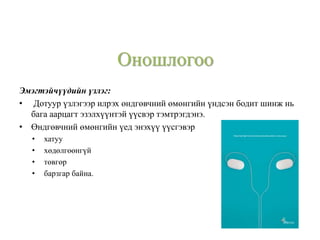 Эмэгтэйчүүдийн үзлэг:
• Дотуур үзлэгээр илрэх өндгөвчний өмөнгийн үндсэн бодит шинж нь
бага аарцагт эзэлхүүнтэй үүсвэр тэмтрэгдэнэ.
• Өндгөвчний өмөнгийн үед энэхүү үүсгэвэр
• хатуу
• хөдөлгөөнгүй
• төвгөр
• барзгар байна.
Оношлогоо
 