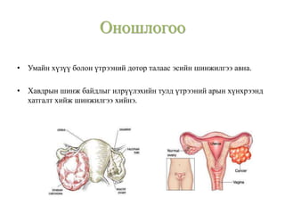 • Умайн хүзүү болон үтрээний дотор талаас эсийн шинжилгээ авна.
• Хавдрын шинж байдлыг илрүүлэхийн тулд үтрээний арын хүнхрээнд
хатгалт хийж шинжилгээ хийнэ.
Оношлогоо
 