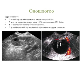 Дүрс оношлогоо
• Хэт авиагаар хэвлийг шинжлэхэд мэдрэг чанар 62-100%,
• Үтрээгээр шинжлэхэд мэдрэг чанар 100%, өвөрмөц чанар 97% байна.
• КТГ болон өнгөт допплер шинжилгээ хийнэ.
• Үтрээний чанд авиагаар өндгөвчний хорт хавдрыг илрүүлж оношилно
 
