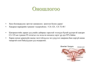 • Хоол боловсруулах эрхтэнг шинжилнэ. /рентген болон дуран/
• Хавдрын маркерийн түвшинг тодорхойлно. / СА-125, СА 72-48 /
• Цэвэршилтийн дараах үед умайн дайвраас гаралтай эзэлхүүн бүхий үүсвэртэй хавсарч
СА 125-ын түвшин 95 нэгж/мл-ээс ихэссэн нөхцөлд эерэг үр дүн 95% байна
• Харин нөхөн үржихүйн насны эмэгтэйчүүдэд энэ үзүүлэлт өвөрмөц биш хоргүй шинж
чанартай олон байдлуудын үед өндөрсөнө.
Оношлогоо
 