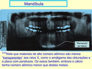 Mandíbula *** Note que materiais de alto número atômico são menos “ transparentes ” aos raios X, como o amálgama das obturações e a placa com parafusos. Os ossos também, embora o cálcio tenha número atômico menor que destes metais. “ Remendo” de titânio 