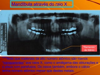 Mandíbula através do raio X
***Note que materiais de alto número atômico são menos
“transparentes” aos raios X, como o amálgama das obturações e
a placa com parafusos. Os ossos também, embora o cálcio
tenha número atômico menor que destes metais.
“Remendo”
de titânio
 