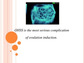 OHSS is the most serious complication  of ovulation induction. 