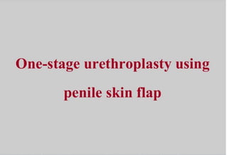 One stage urethroplasty of penile urethra using penile skin flap