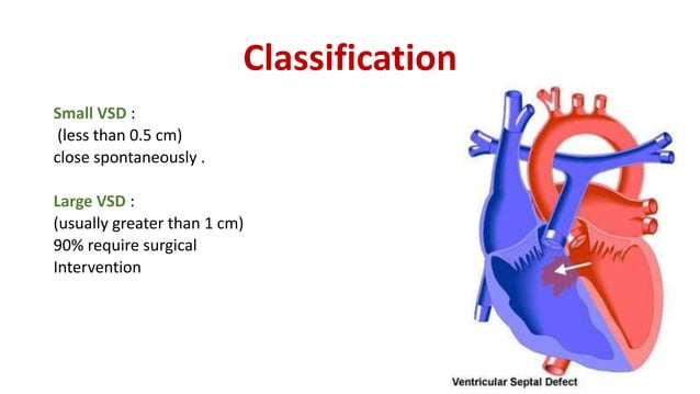 ventricular septal defect | PPTX | Heart and Cardiovascular Diseases ...