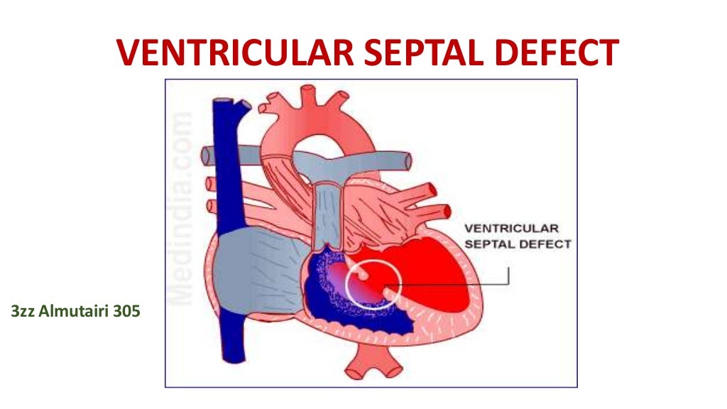 ventricular septal defect