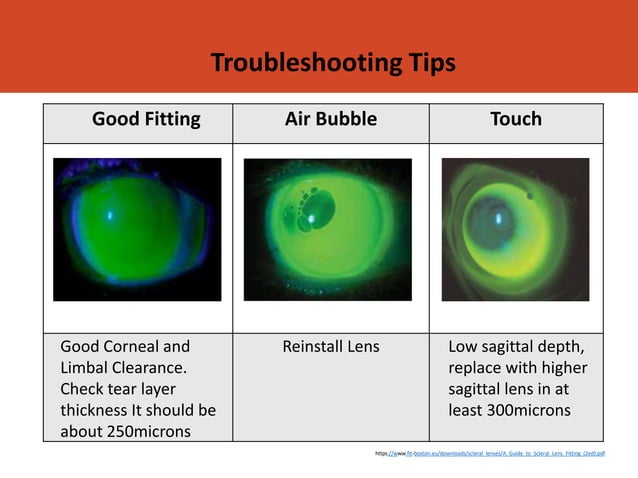 ONE FIT SCLERAL LENS.ppt | Eye and Vision Conditions | Diseases and ...
