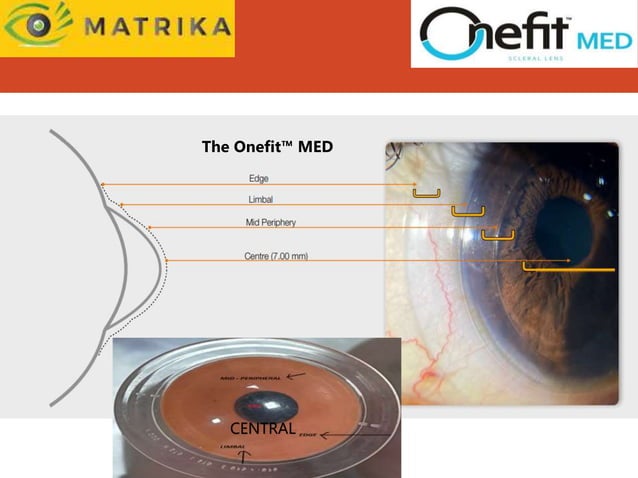 ONE FIT SCLERAL LENS.ppt | Eye and Vision Conditions | Diseases and ...