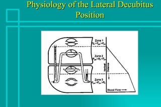 Lld Vs Rld One Lung Ventilation | PPT