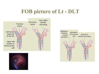 One lung ventilation | PPT