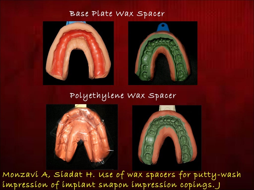 Modified One Step Putty Wash Technique