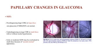 Optic Nerve Head Evaluation.pptx