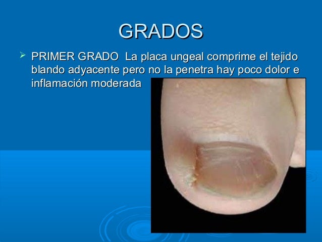 La crema del hongo sobre los altos