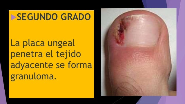 Que curar el hongo a la mamá que da de comer