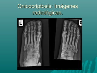 Onicocriptosis: ImágenesOnicocriptosis: Imágenes
radiológicas.radiológicas.
 
