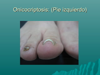 Onicocriptosis: (Pie izquierdo)Onicocriptosis: (Pie izquierdo)
 