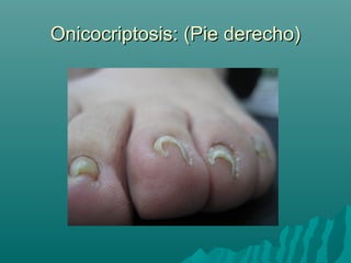 Onicocriptosis: (Pie derecho)Onicocriptosis: (Pie derecho)
 