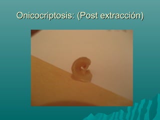 Onicocriptosis: (Post extracción)Onicocriptosis: (Post extracción)
 