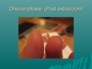 Onicocriptosis: (Post extracción)Onicocriptosis: (Post extracción)
 