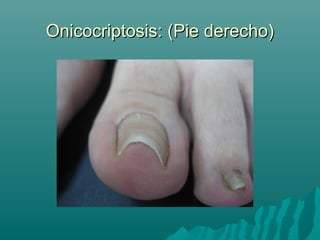 Onicocriptosis: (Pie derecho)Onicocriptosis: (Pie derecho)
 