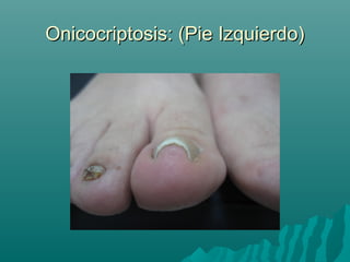 Onicocriptosis: (Pie Izquierdo)Onicocriptosis: (Pie Izquierdo)
 