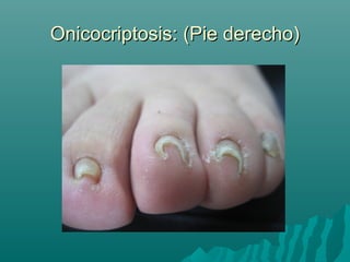 Onicocriptosis: (Pie derecho)Onicocriptosis: (Pie derecho)
 