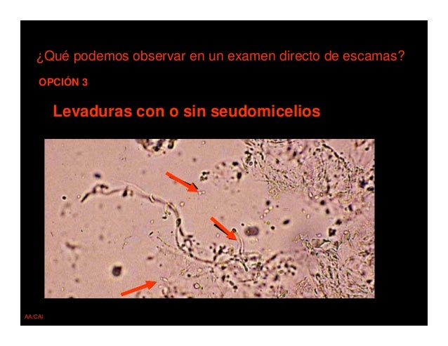 Como curar el hongo sobre las uñas de la mano
