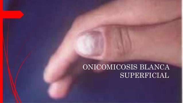 El medio bueno para el tratamiento del hongo de las uñas en el pie